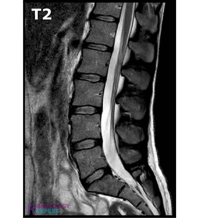 Mri Lumbar Spine 9198